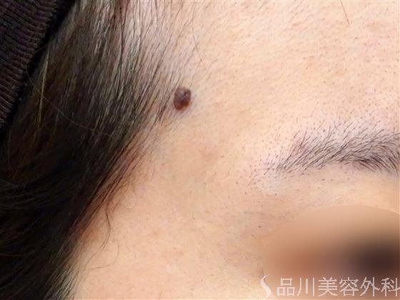 症例NO.57539のBEFORE写真