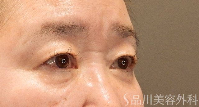 症例NO.75353のBEFORE写真