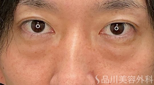 症例NO.74221のBEFORE写真