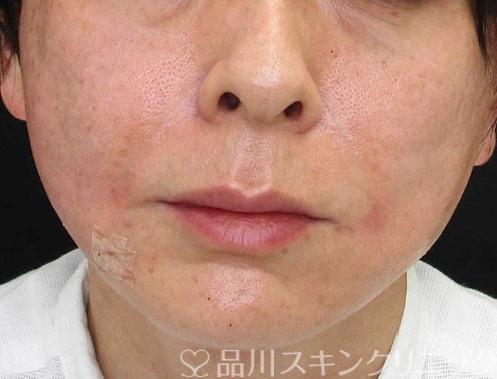 症例NO.65121のAFTER写真