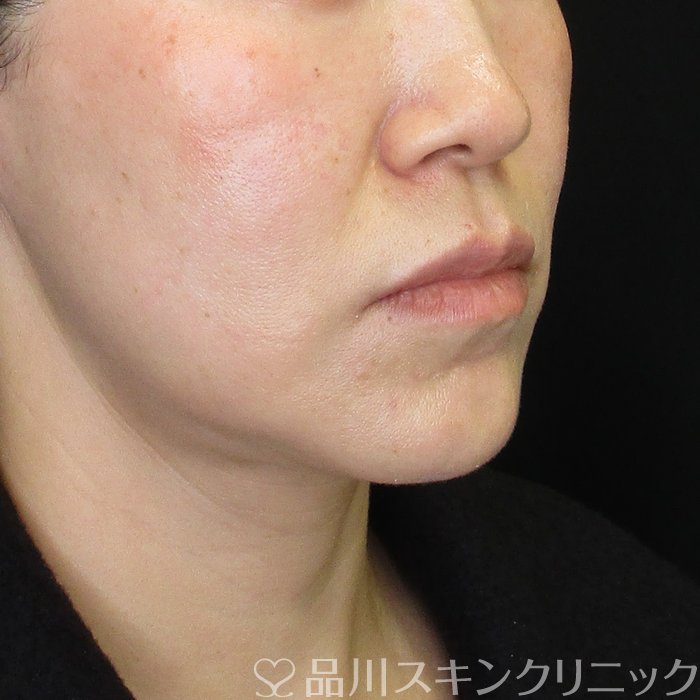 症例NO.74374のBEFORE写真