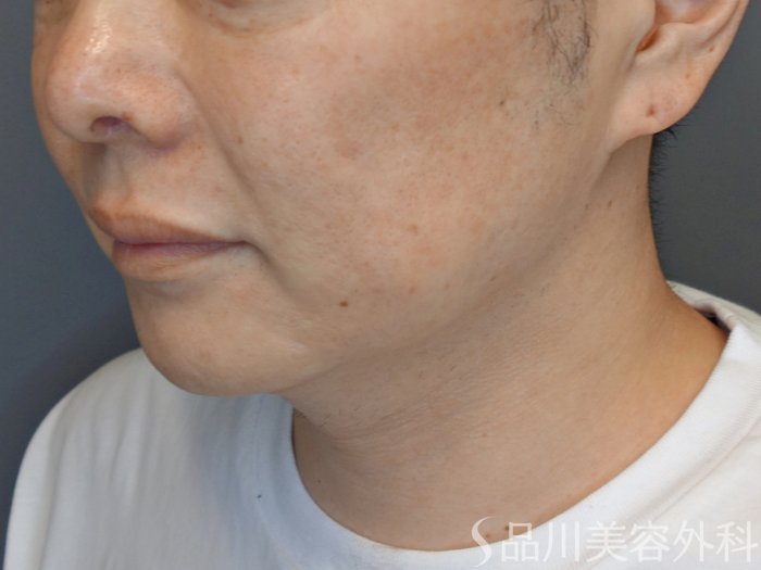 症例NO.70338のBEFORE写真