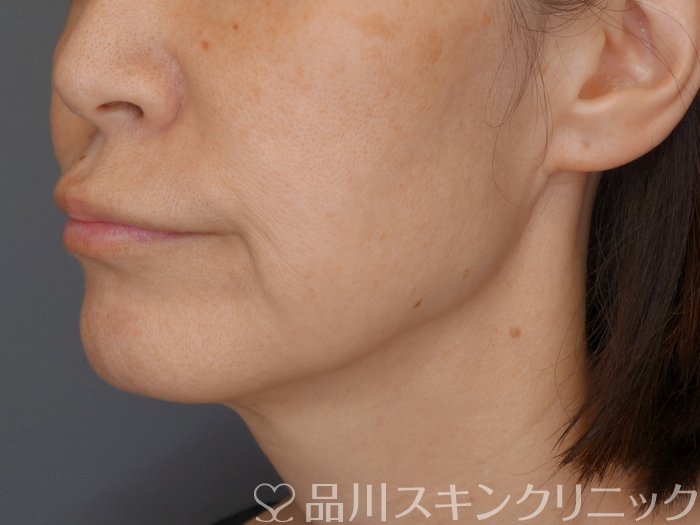 症例NO.71273のBEFORE写真