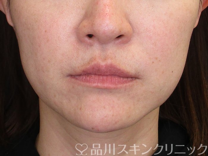 症例NO.72630のAFTER写真