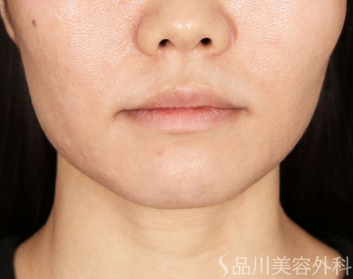 症例NO.71281のAFTER写真