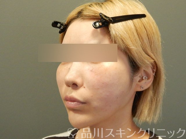 症例NO.65754のAFTER写真