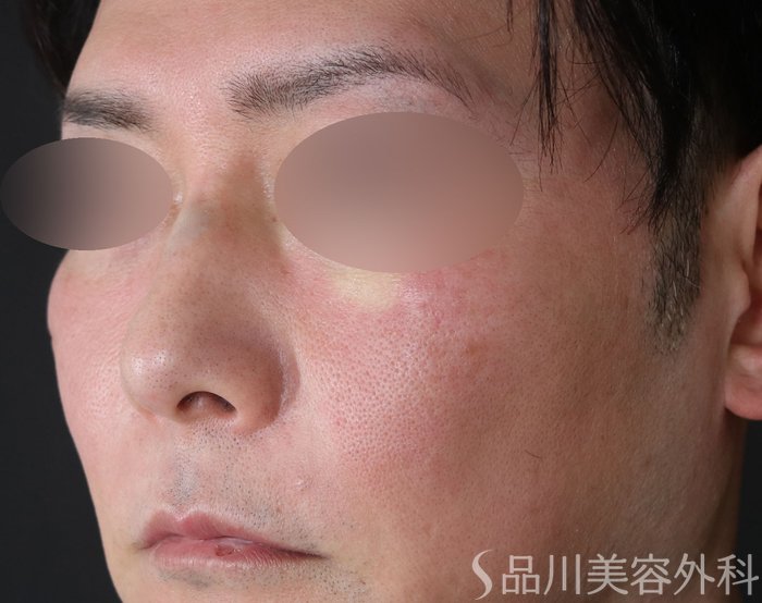 症例NO.72877のAFTER写真