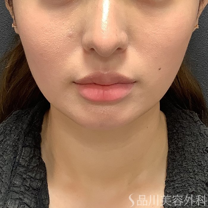 症例NO.75326のAFTER写真