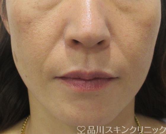 症例NO.32796のBEFORE写真