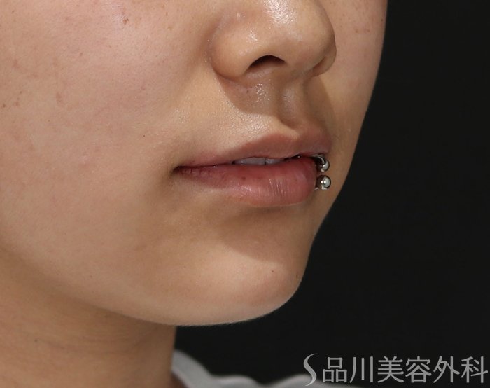 症例NO.71359のAFTER写真