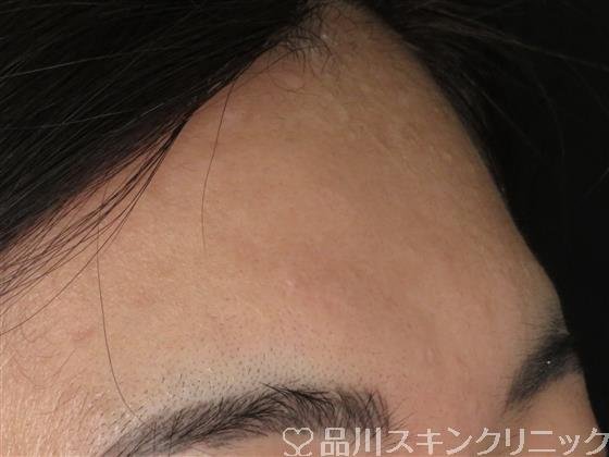 症例NO.49118のBEFORE写真