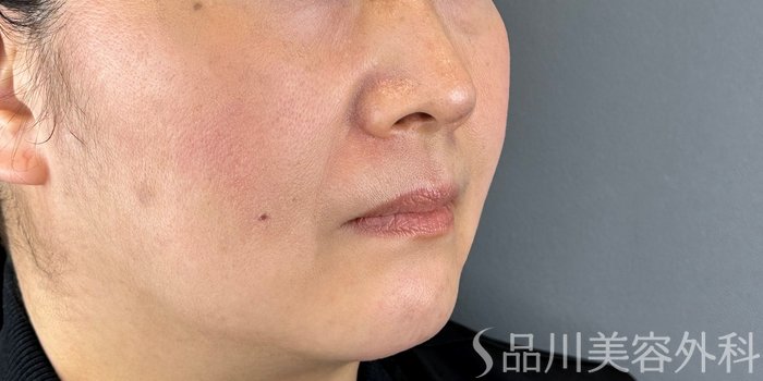 症例NO.70703のBEFORE写真