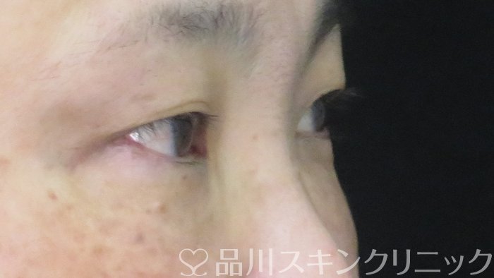 症例NO.72050のAFTER写真