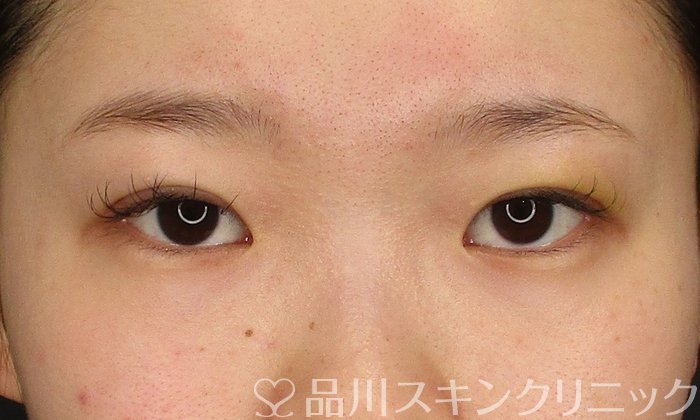 症例NO.69700のAFTER写真