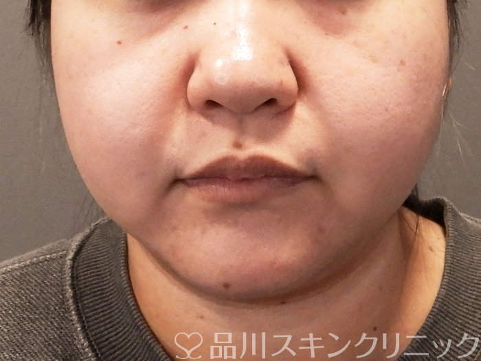 症例NO.69644のBEFORE写真
