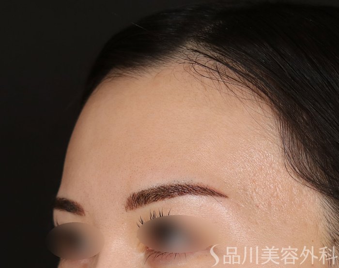 症例NO.73682のBEFORE写真