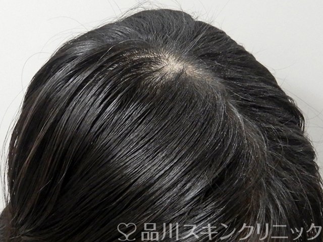症例NO.69315のAFTER写真