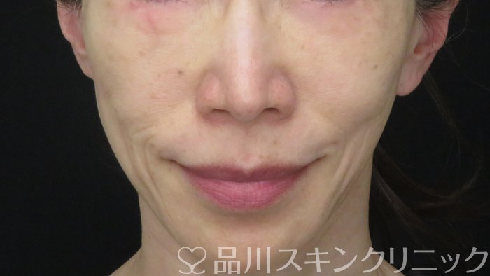 症例NO.71026のBEFORE写真