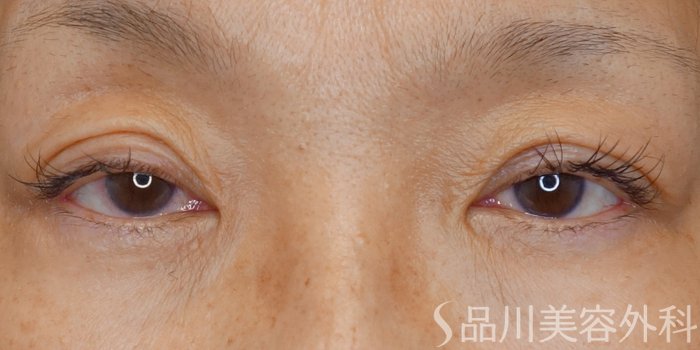 症例NO.70646のAFTER写真