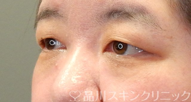 症例NO.64096のBEFORE写真
