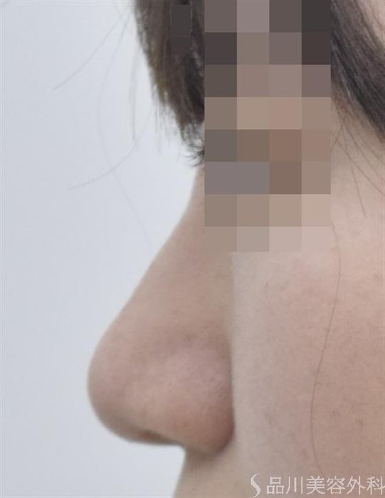 症例NO.47698のAFTER写真