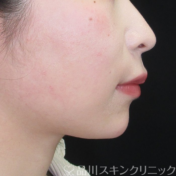 症例NO.75325のAFTER写真