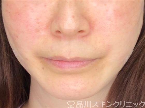症例NO.60962のAFTER写真