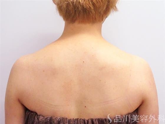 症例NO.52794のBEFORE写真
