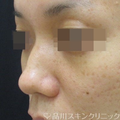 症例NO.71707のBEFORE写真