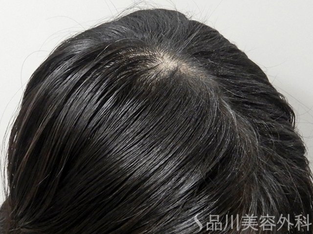 症例NO.69315のAFTER写真