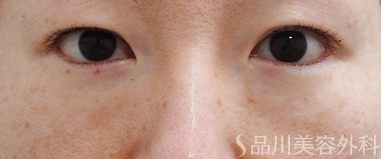 症例NO.70835のBEFORE写真