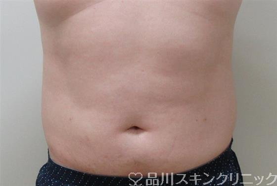 症例NO.32799のAFTER写真