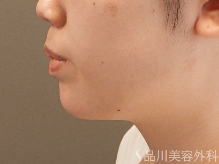 症例NO.70972のAFTER写真