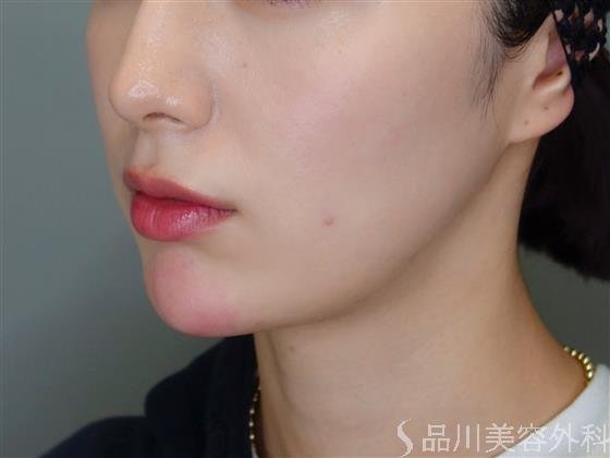 症例NO.50832のAFTER写真