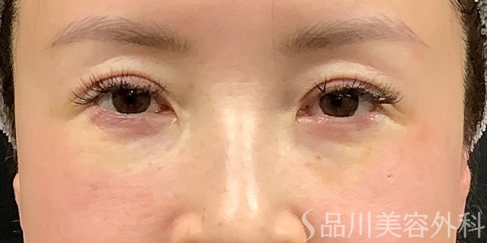 症例NO.71232のAFTER写真