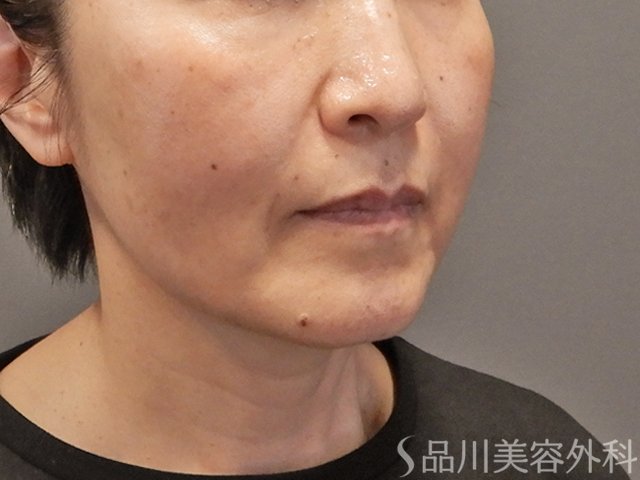 症例NO.75060のAFTER写真