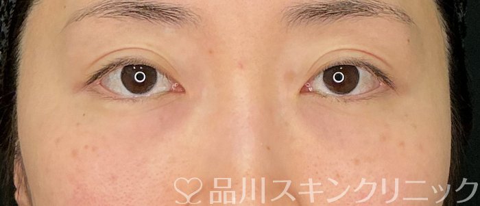 症例NO.74914のBEFORE写真