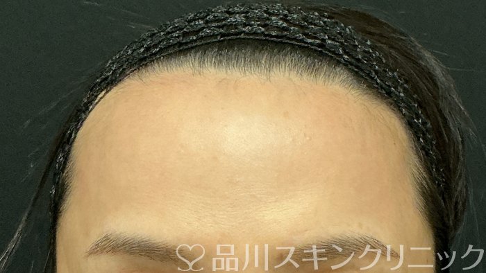 症例NO.74663のBEFORE写真