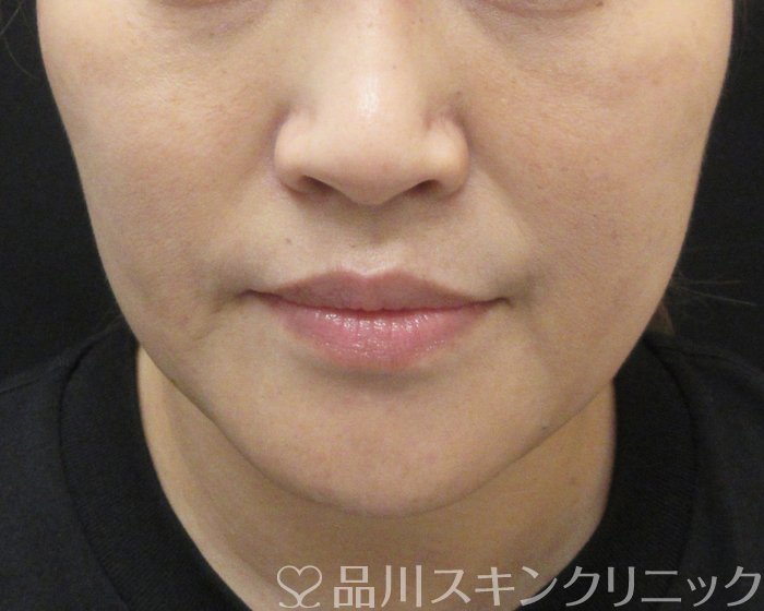 症例NO.69215のBEFORE写真