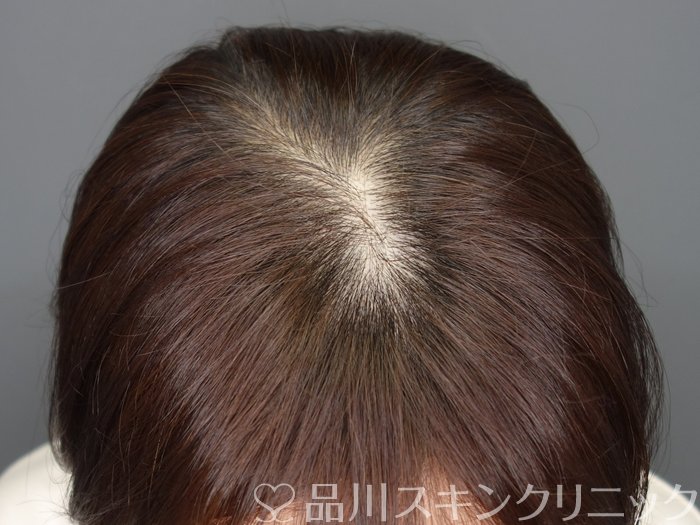 症例NO.73306のAFTER写真