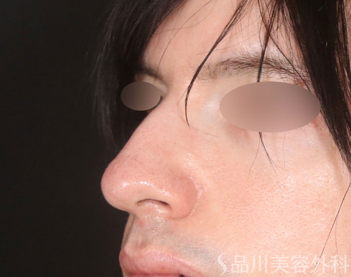 症例NO.72932のBEFORE写真