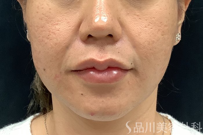 症例NO.73310のAFTER写真