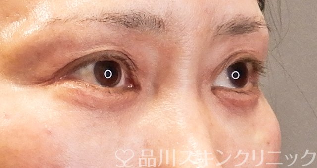 症例NO.63786のAFTER写真
