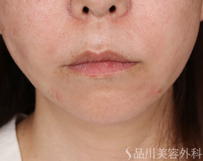 症例NO.71908のAFTER写真