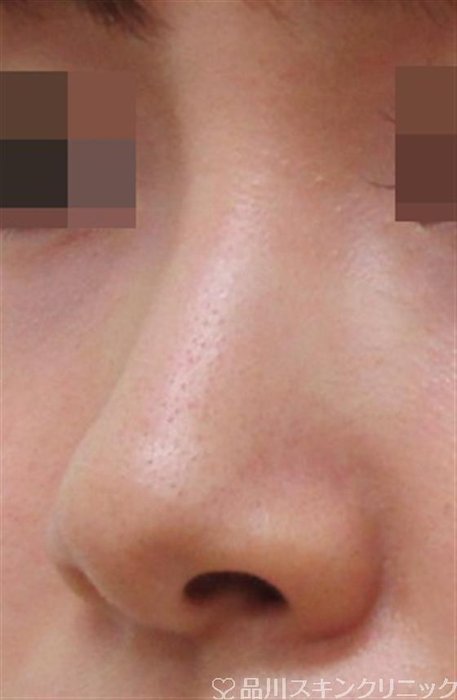 症例NO.32232のBEFORE写真