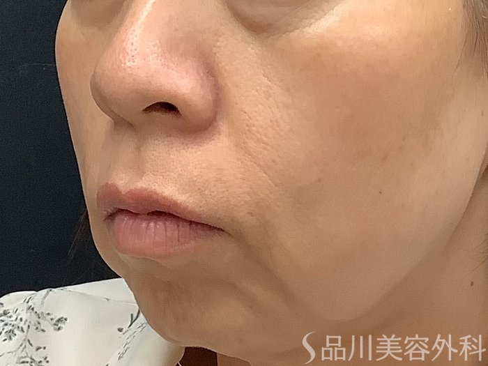 症例NO.67843のBEFORE写真