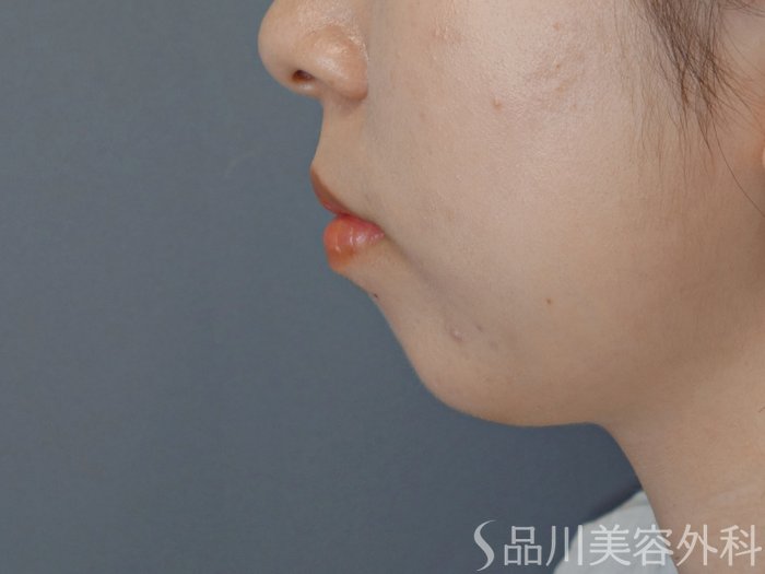 症例NO.70681のBEFORE写真