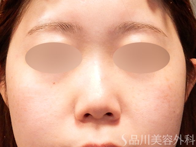 症例NO.69913のBEFORE写真