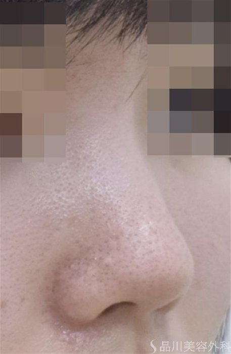 症例NO.52913のBEFORE写真