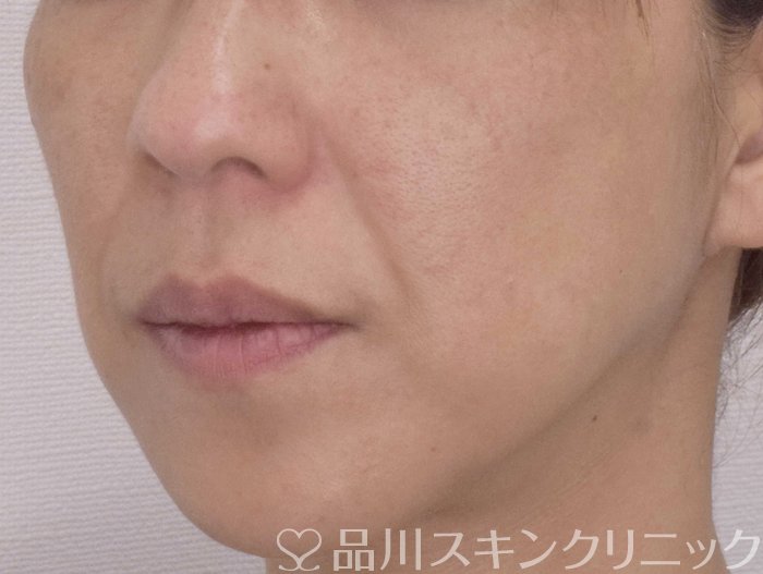 症例NO.72314のBEFORE写真